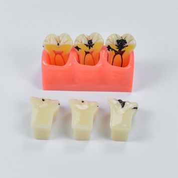 Modèle d'étude sur les caries