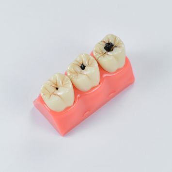 Modèle d'étude sur les caries
